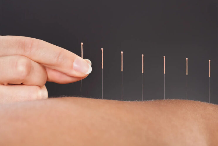 accupuncture