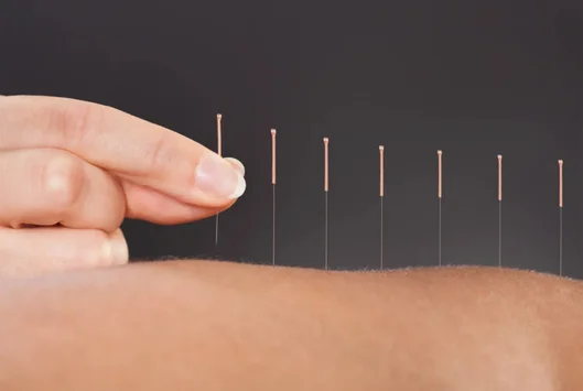 accupuncture